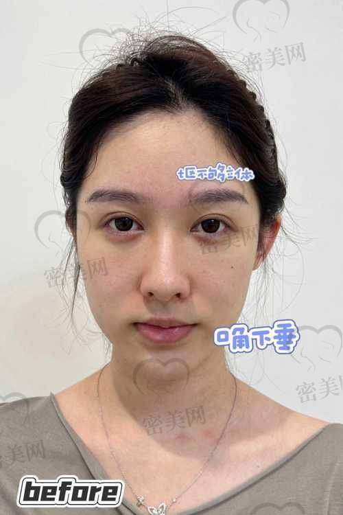 重庆华美紫馨张平全方面部脂肪填充：口碑爆棚的秘密