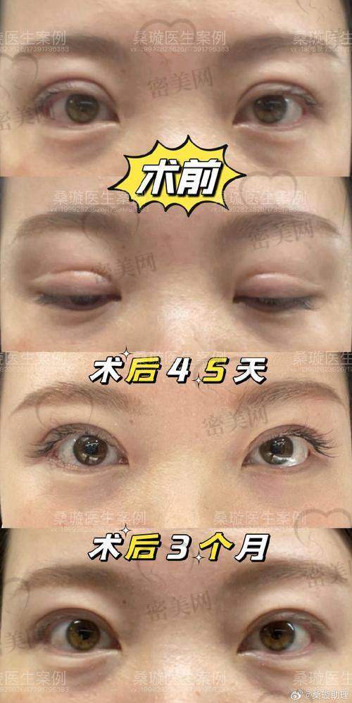 刘志刚的眼修复手术收费贵不贵？