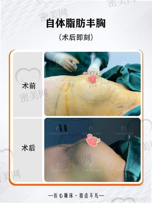 奥美定取出后乳房是不是报废了？