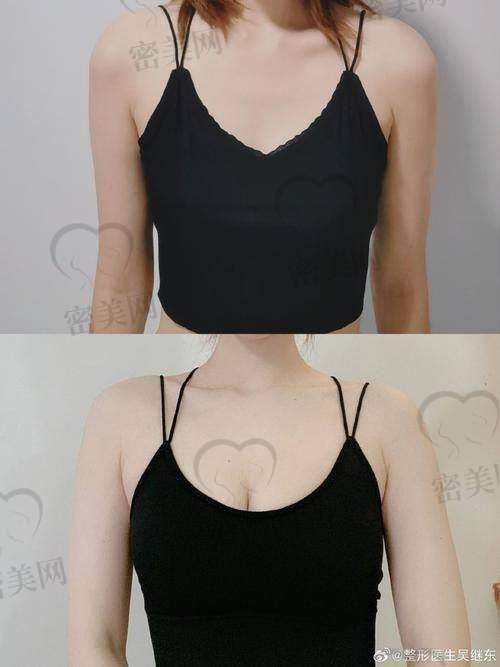 20年前流行注射丰胸都用了啥材料？