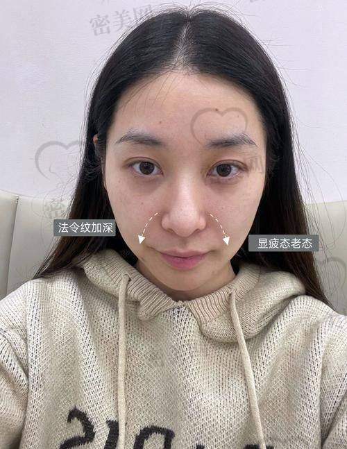方法五：面部提升手术
