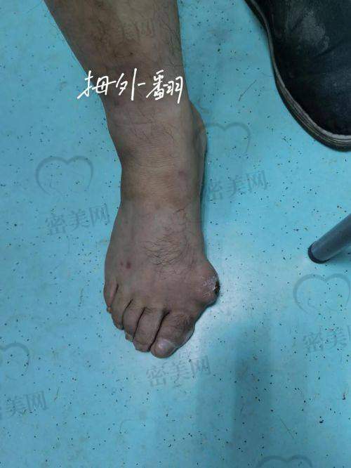 修复大脚骨手术主要问题类型与苏敬达应对技术