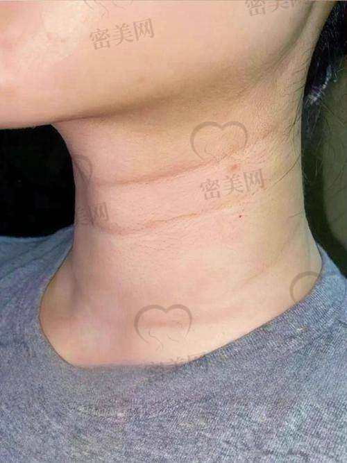 颈纹嗨体注射的维持时间