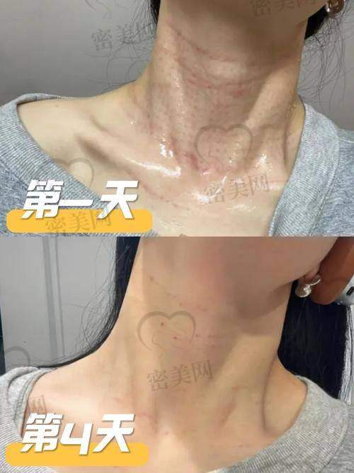 颈纹嗨体注射的注意事项