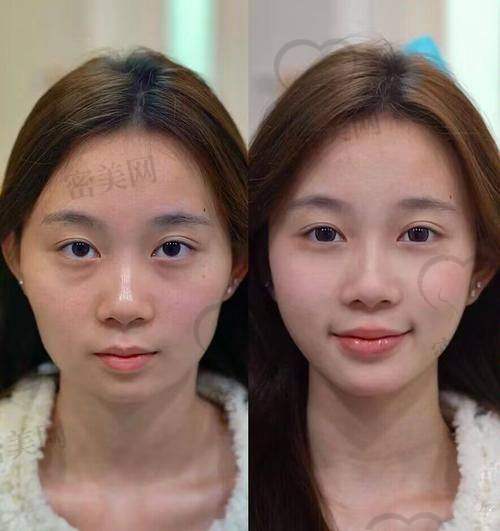 填充后的护理注意事项