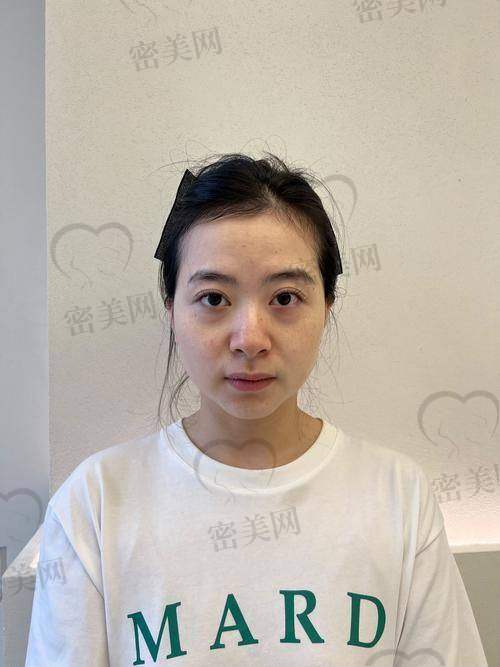 玻尿酸填充脸颊