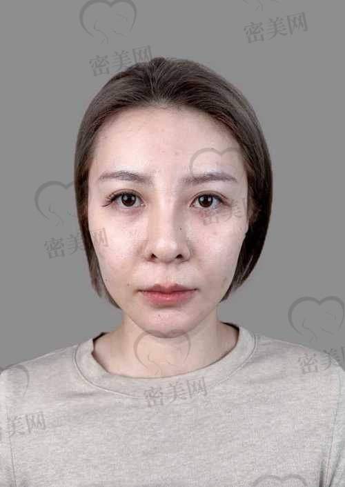 自体脂肪填充脸颊