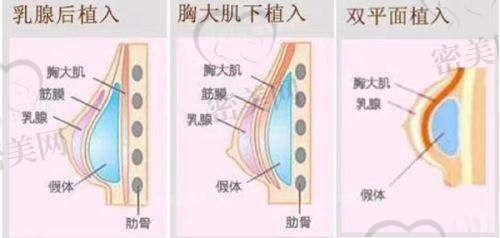 傲诺拉假体价格剖析