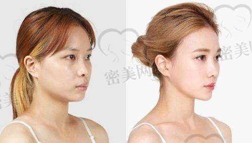 为什么说王艳鼻整形的审美更契合大众需求？