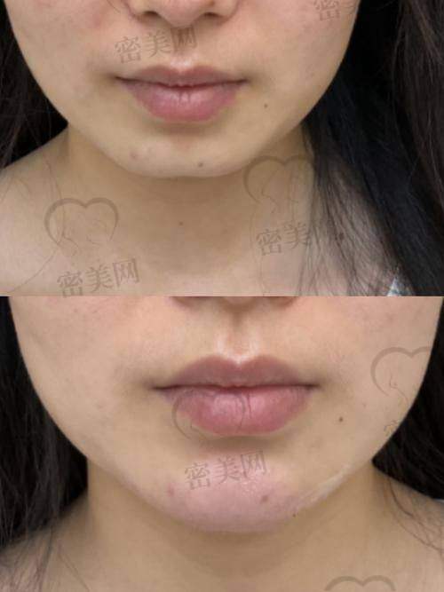 润致玻尿酸的区别