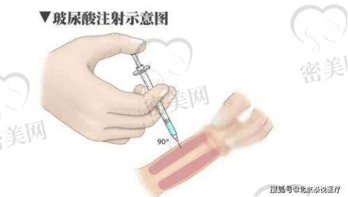 优选医院与玻尿酸项目