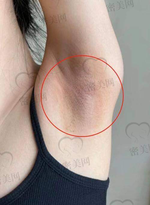 技术优势大揭秘：石家庄美联臣郭东超除腋臭为何这么牛？