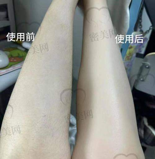 大连口碑较好的激光脱毛医院一览表