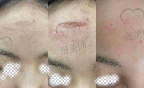 用户真实反馈：深圳福华点阵激光评价怎么样？
