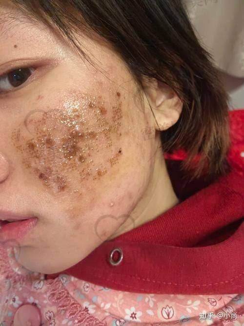 深圳福华医疗美容医院点阵激光治疗流程解析