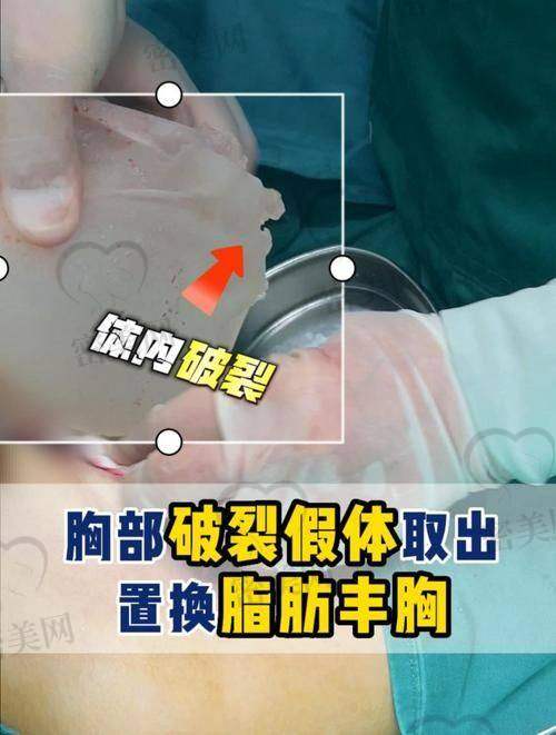 傲诺拉假体隆胸医院选择攻略