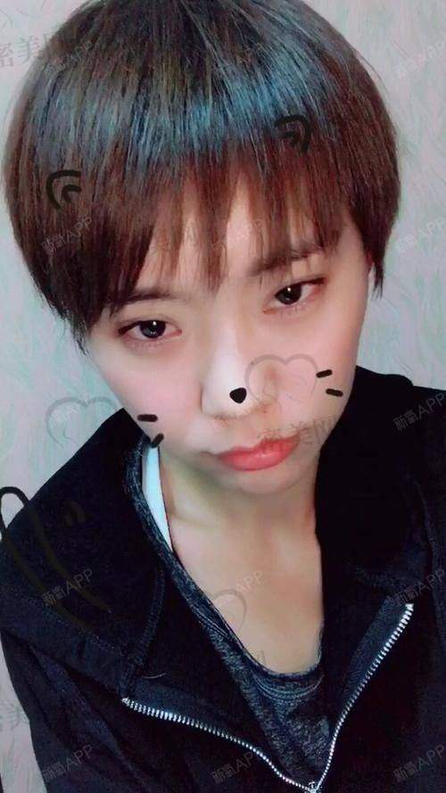 什么是自体脂肪丰眼窝