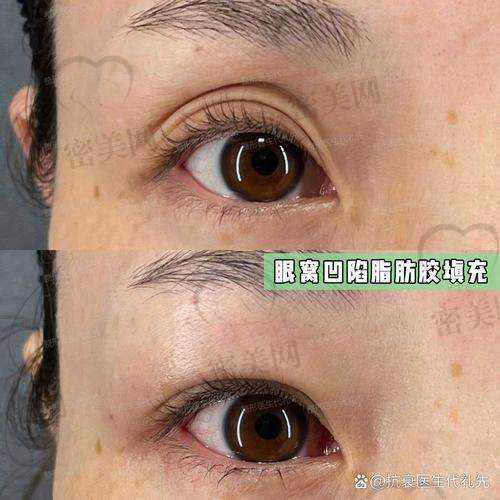 自体脂肪丰眼窝的成活率