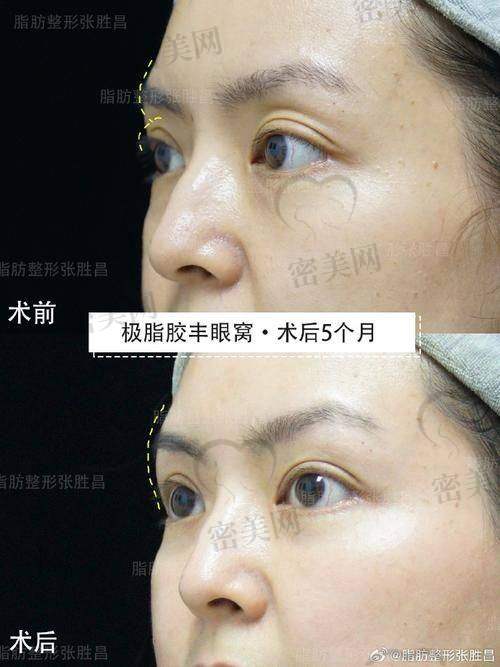 自体脂肪丰眼窝的危险和失败情况