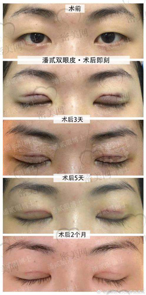 真人实例：15000 元打造的灵动双眸