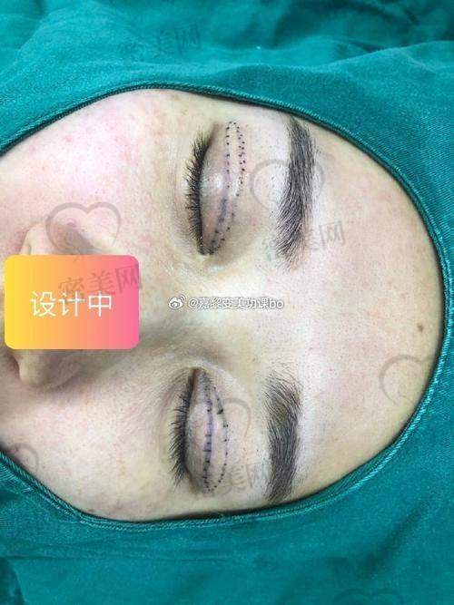 淄博爱美汇医疗美容：林羽清医生，抗瘢痕线材应用先锋