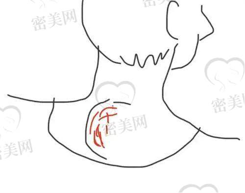 真实用户反馈:富贵包吸脂、术后反馈“美+有用”两手抓