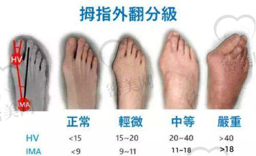温建民微创拇外翻手术有哪些特别之处？