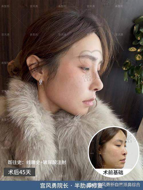 重庆米兰柏羽时光整形医院韦小勇无假体隆鼻：口碑爆棚的秘密