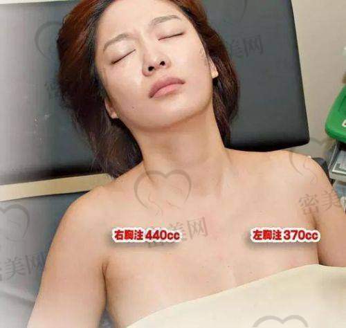 术后护理和注意事项