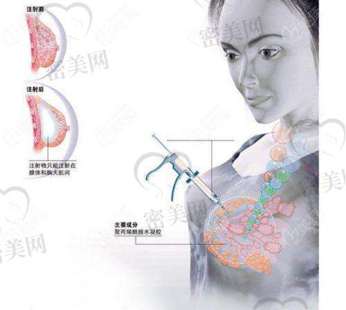 傲诺拉假体的材质和科技感,值不值这个价格?