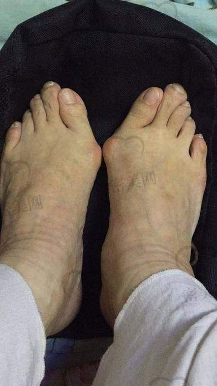 做完手术后修复难不难？
