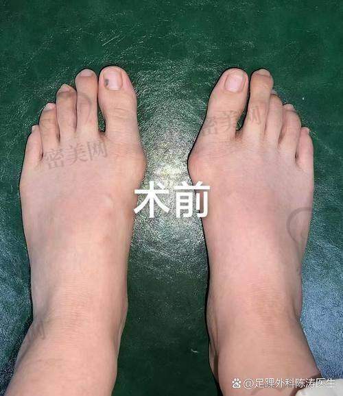 真实患者反馈！术后1天走路、3天出门，半年穿回高跟鞋