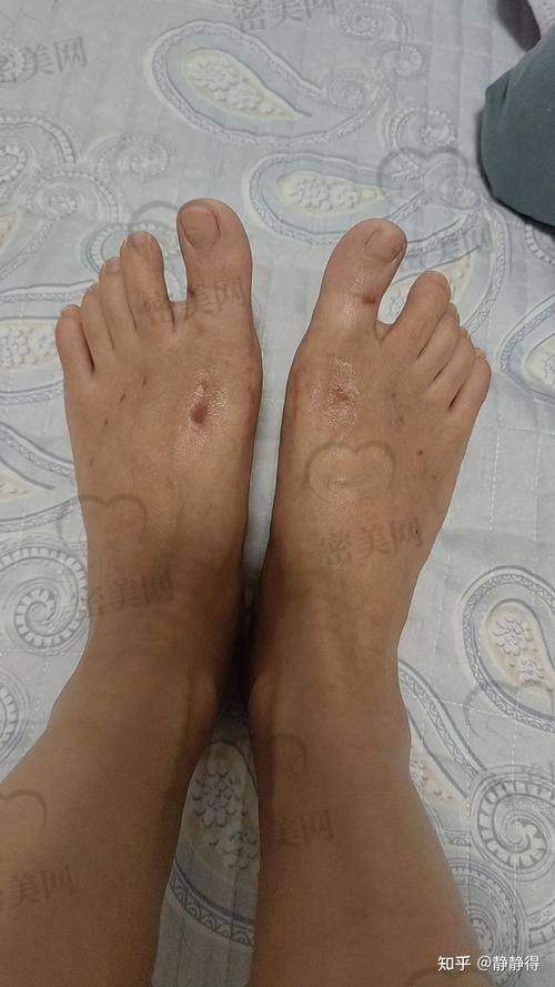 怎么预约苏敬达拇外翻手术更划算？