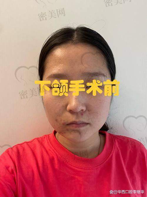 石家庄美联臣整形医院高玉伟下颏整形：口碑爆棚，真人实例见证奇迹！
