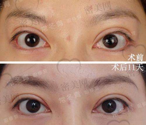 王亚斌医生：5000 元起双眼皮的技术优势大揭秘