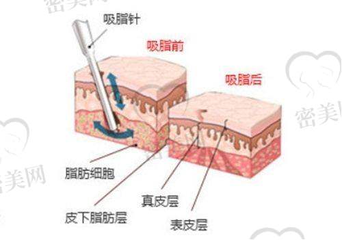 石家庄美莱整形医院石亮单部位吸脂：精细技术优势大揭秘