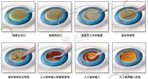 山东省白内障手术免费政策2026年大升级，年龄门槛明确