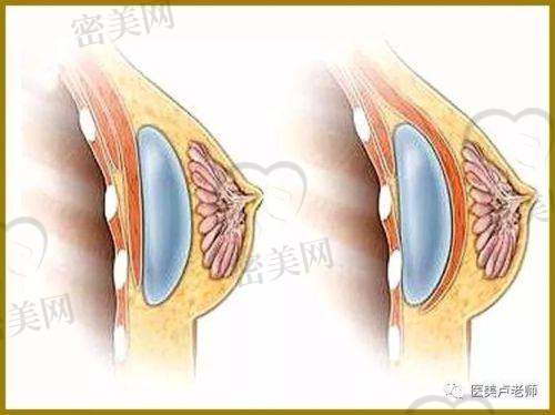 星熠假体高凸vs中凸：显不显大一目了然