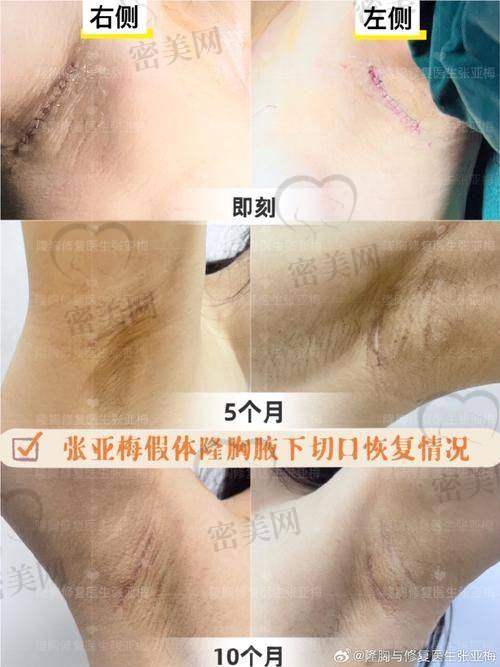 傲诺拉假体版本全解析