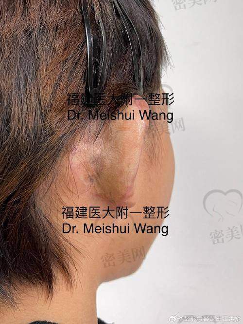 耳整形类型及对应价格明细表