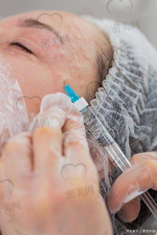 石家庄康蓓妍整形张继伟面部胶原灌注：技术优势大揭秘