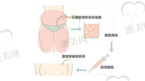 郭震宇医生的“珍珠链注射法”结合CEFFE技术，提升了脂肪丰胸成效的美感和安心系数