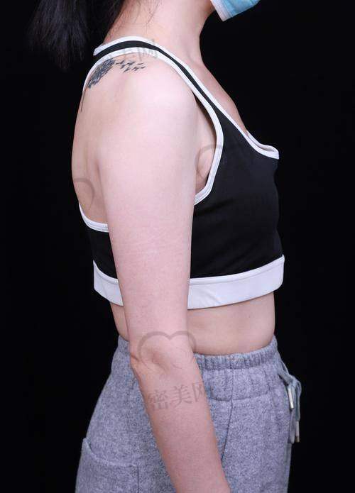 傲诺拉璀璨假体的特点