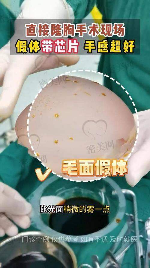 做了傲诺拉隆胸40天，手感到底应该是啥状态？