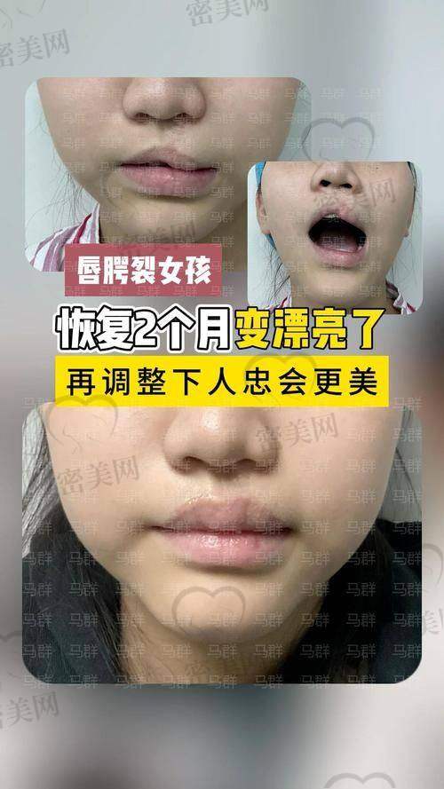 技术优势：高玉伟唇部整形的秘密武器
