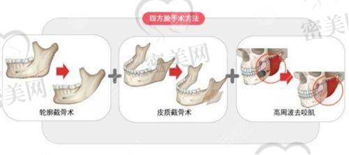 深圳曹孟君医疗美容门诊部：小而精诊所代表