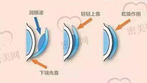 嘉兴爱尔眼科有哪些特色诊疗项目?近视手术是王牌