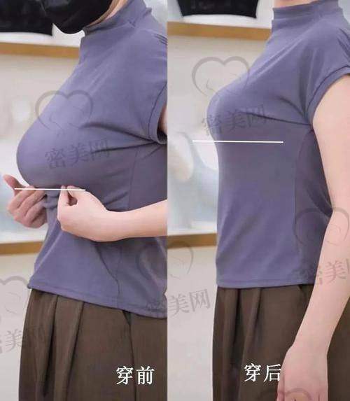 术后成效，惊艳到爆