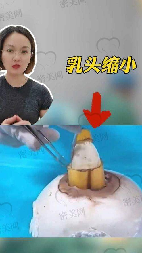 大胸缩小会反弹吗？成都美莱医生观点告诉你答案