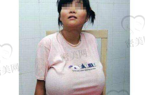 成都美莱缩胸技术如何？术式选择与方案设计亮点汇总